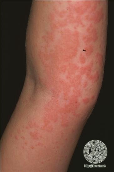 アレルギー 写真 鯖 蕁麻疹
